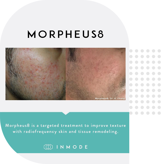 A picture of morpheus 8 skin treatment.