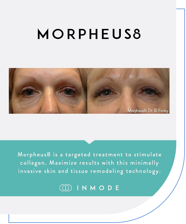 A picture of morpheus 8 before and after the procedure.