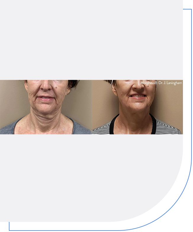 A woman 's face before and after undergoing facelift surgery.