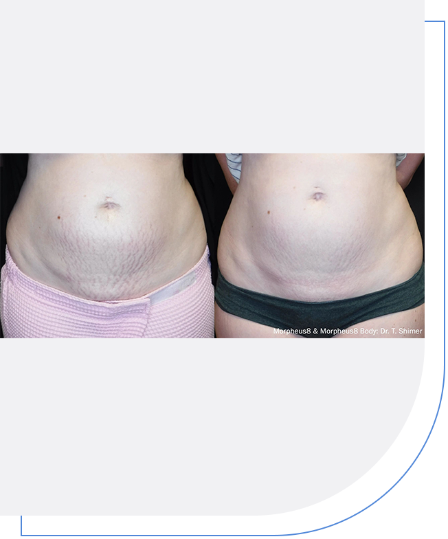 A woman 's stomach before and after liposuction.